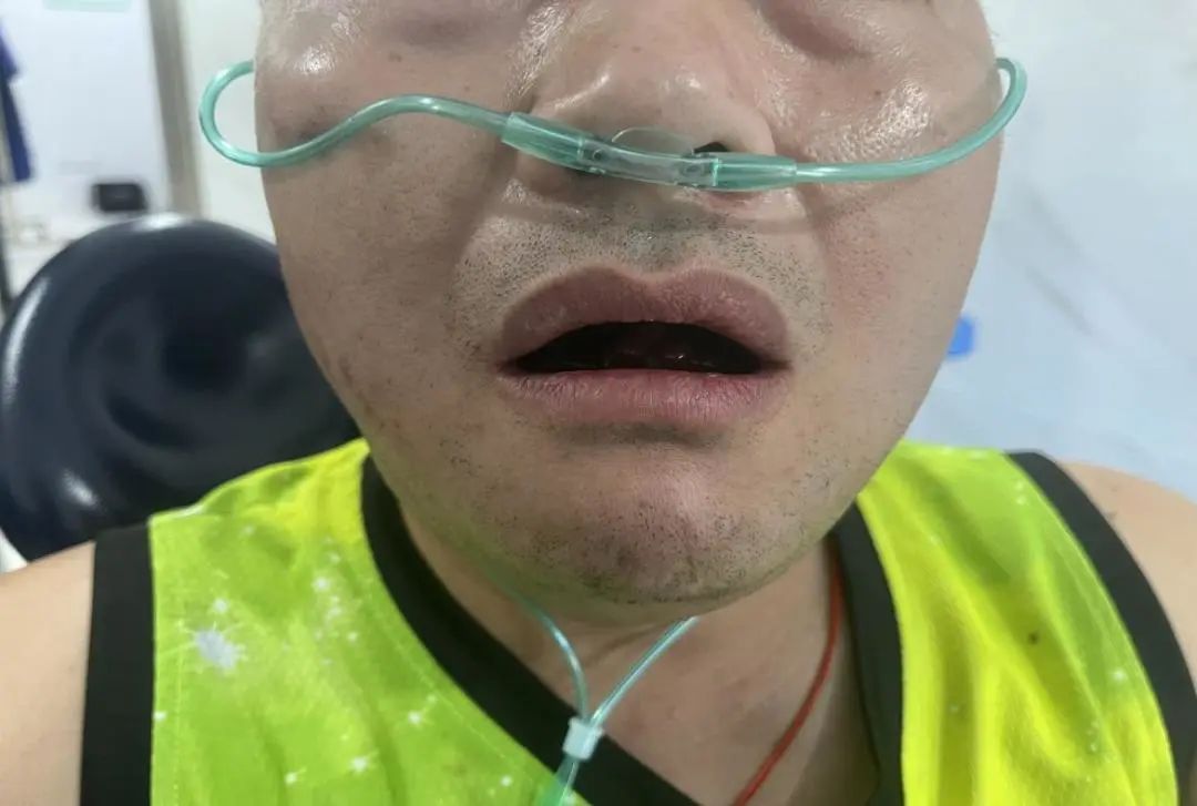 种植牙无小事,口底出血可危及生命!