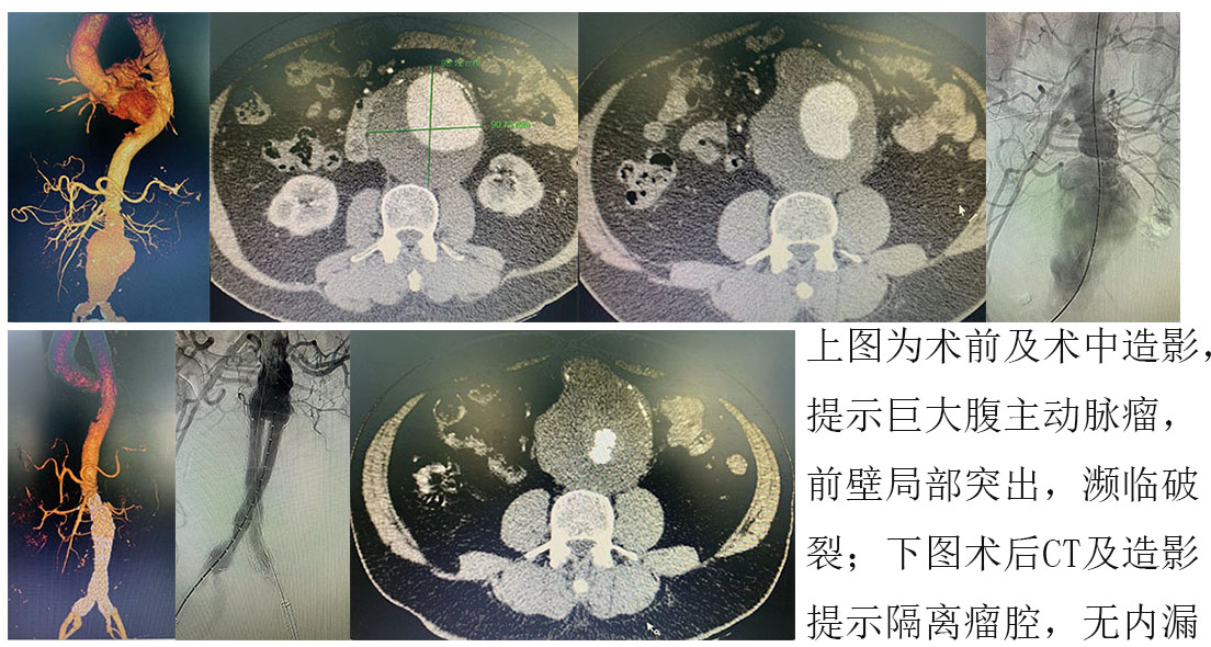61岁患者腹主动脉瘤先兆破裂，微创手术成
